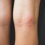 A close-up view of a cluster of red, inflamed bed bug bites on the back of a person's legs.