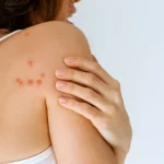 A woman touching a cluster of red, inflamed bed bug bites on her shoulder and upper back.