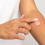 A person applying soothing white topical cream to a red welt on their forearm to treat itchy bed bug bites.